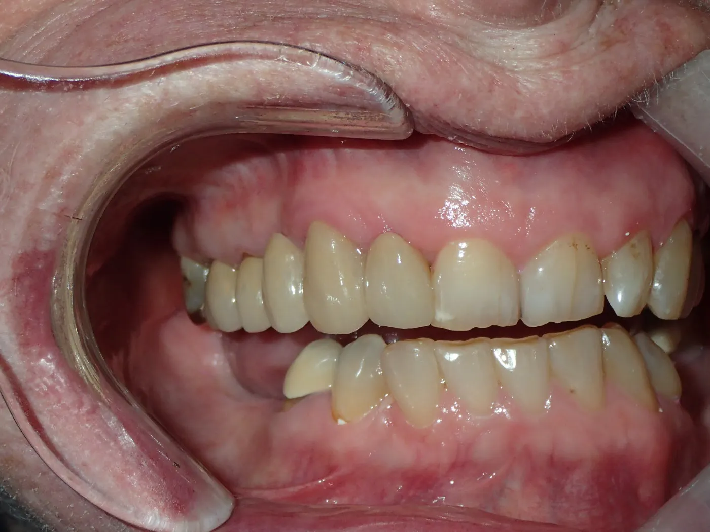After: clinical photo with a cheek retractor showing a complete row of upper front teeth restored with a dental bridge